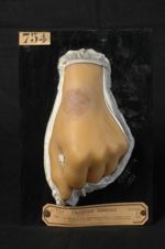 Kérion de Celse ; trichophytie sycosique du poignet ; sycosis parasitaire