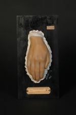 Acroasphyxie (Inv. 1922). Asphyxie locale des extrémités, survenue chez une femme scrofuleuse