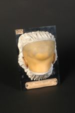 Pelade, limitée symétriquement à la zone du nerf occipital, aucun autre point du cuir chevelu n'étan [...]