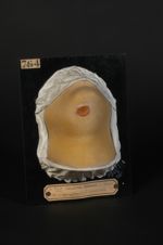 Chancre syphilitique de la région sus-hyoïdienne