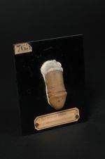 Gale ; lésions du pénis