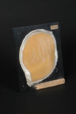 Vergetures ; stries atrophiques de la région abdominale, produites rapidement par la distension de l [...]