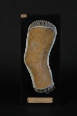 Syphilide de la période secondaire. Femme âgée de 32 ans : 1° macules, traces d'une première éruptio [...]