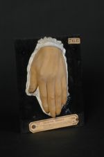 Stries des ongles; arrêt de développement presque complet de quelques ongles pendant l'évolution d'u [...]