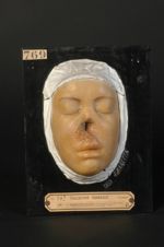 Syphilide ulcéro-gommeuse avec destruction du nez. Femme âgée de 24 ans, chiffonnière