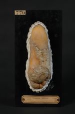 Eczéma corné de la plante du pied