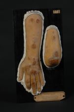 Leishmaniose cutanée sud-américaine probable (Inv. 1922). Papillomes ; ulcérations, cicatrices, sclé [...]