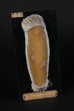 Lichen plan corné à grands disques