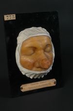 Rhinophyma (Inv. 1922). Acné hypertrophique, variété éléphantiasique ; couperose