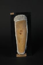 Gommes scrofulo-tuberculeuses de la jambe