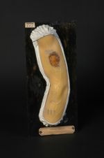 Syphilide tertiaire ulcéreuse développée sur un tatouage du bras. Homme âgé de 21 ans, couvreur