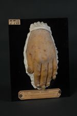 Maladie de Duhring (Inv. 1922). Homme âgé de 21 ans