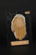 Déformations des doigts, liées à une cyanose ancienne. Insuffisance tricuspidienne et rétrécissement [...]