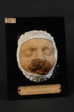 Épithéliome spino-cellulaire (Inv. 1922) végétant de l'aile du nez