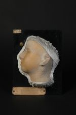 Pityriasis rubra pilaire. Pityriasis pilaire (Hillairet). Diagnostic contesté. (V. obs. par Vidal in [...]