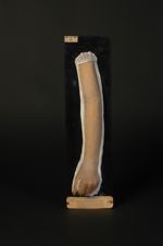 Pityriasis rubra pilaire. Pityriasis pilaire (Hillairet). Diagnostic contesté (V. obs. par Vidal in  [...]