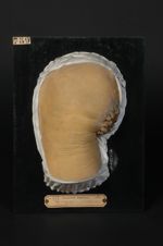 Lupus végétant corné, à marche serpigineuse ; tuberculose verruqueuse de la région fessière. Homme â [...]