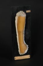 Sclérodermie en plaques ; morphée. Homme âgé de 21 ans (V. les n° 841, cuisse, et 1142, langue du mê [...]