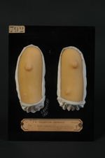 Chéloïdes cicatricielles du bras, ayant débuté pendant la cicatrisation de pustules vaccinales ; enf [...]