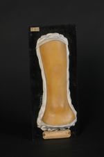 Taches arsenicales de la jambe, survenues au cours du traitement d'un psoriasis