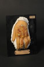 Lésions trophiques, bulles et ulcérations des mains. Homme âgé de 25 ans, pâtissier