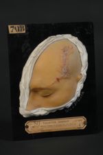 Adénomes sébacés non symétriques (Inv. 1922). Homme âgé de 25 ans, cordonnier