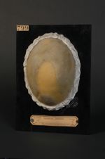 Favus. Cicatrices de favus ancien ; le favus existe encore en activité sur les bordures de la presqu [...]