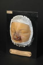 Syphilide gommeuse du nez. Femme âgée de 45 ans, mécanicienne