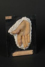 Dactylite tuberculeuse du pouce et de l'index. Synovites fongueuses. Homme âgé de 17 ans