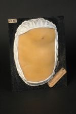 Syphilide papuleuse miliaire du tronc. Homme âgé de 18 ans