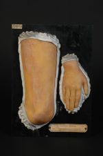 Erythème polymorphe. Erythème papuleux desquamatif. Jeune fille âgée de 17 ans