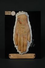 Dermatite polymorphe douloureuse (Inv. 1922). Homme âgé de 51 ans