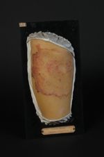 Lupus tuberculeux de la cuisse. Homme âgé de 17 ans