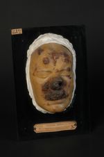 Syphilides tuberculo-ulcérantes généralisées. Syphilide perforante du  nez. Syphilis mutilante. Homm [...]