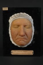 Acné rosée ; couperose érythémato-pustuleuse de la face. Homme âgé de 63 ans, cocher