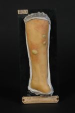 Erythème polymorphe, vésiculeux et bulleux