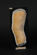 Erythème noueux (Inv. 1922). Erythème multiforme à gros nodules et à grandes plaques, forme prolongé [...]