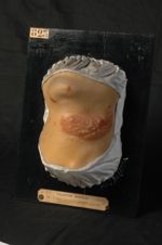 Kérion de Celse (Inv. 1922). Trichophytie, forme sycosique, anthracoïde, du cou. Homme âgé de 30 ans