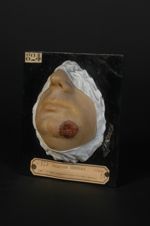 Chancre syphilitique du menton