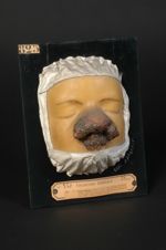 Lupus ulcéreux végétant du nez ; lupus exubérant de Fuchs ; marche destructive rapide. Jeune homme â [...]