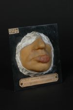 Chancre syphilitique de la lèvre inférieure ; syphilides papuleuses concomitantes