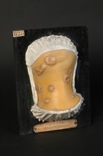 Syphilides papulo-croûteuses hypertrophiques secondaires ; plaques syphilitiques géantes de la nuque [...]