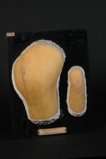 Erythème marginé urticans