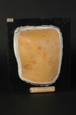 Syphilide circinée à larges papules, du dos. Homme âgé de 58 ans