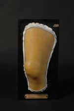 Purpura aigu. Femme âgée de 52 ans