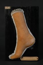 Eczéma de la jambe avec début de transformation papillomateuse