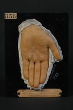 Dyshidrose palmaire (Inv. 1889). Homme âgé de 20 ans, dessinateur