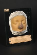 Lupus tuberculeux du nez. Lupus vulgaire, lupus de Willan. Forme ulcéreuse à évolution rapide, dével [...]