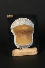 Folliculite cicatricielle, voisine du sycosis lupoïde (Inv. 1922). Folliculite pilo-sébacée lupoïde. [...]