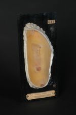 Sclérodermie en plaques ; morphée blanche plane, de la cuisse, plaques en voie de guérison. Homme âg [...]